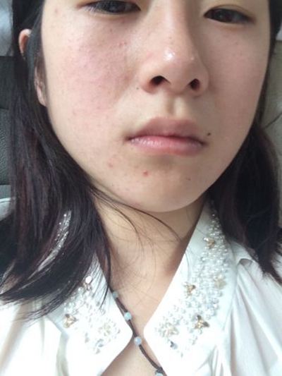 鼻子长螨虫症状图片 (22)