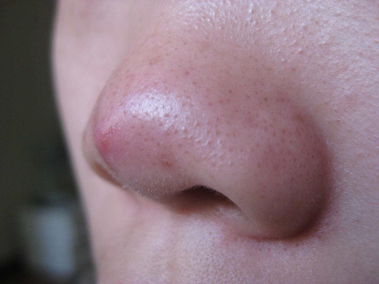 鼻子长螨虫症状图片 (32)