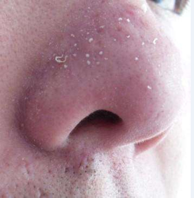 鼻子长螨虫症状图片 (38)