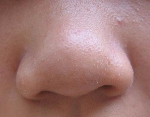 鼻子长螨虫症状图片 (54)