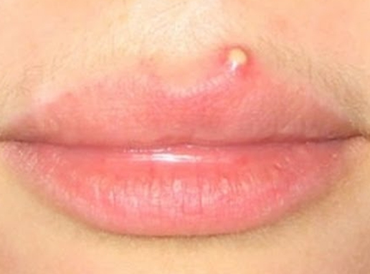 嘴唇白色念珠菌的图片图片