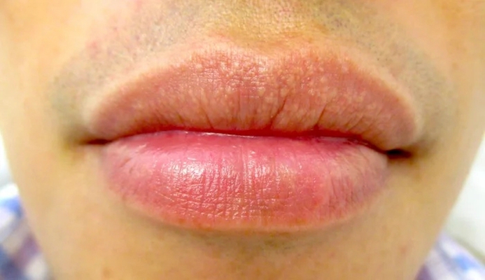 艾滋病早期嘴唇现状图片