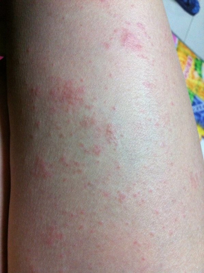 血热湿毒的皮肤症状图片