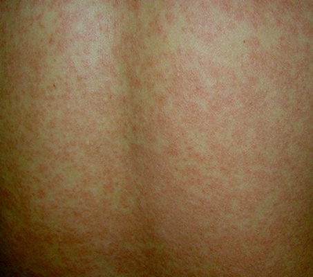 常见的六种荨麻疹图片图片