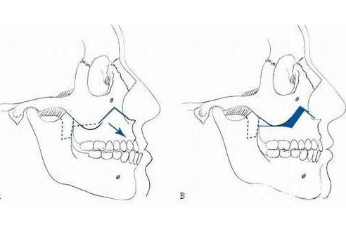正颌手术 (10)