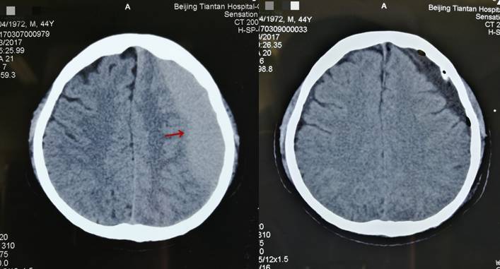 (慢性硬膜下血腫鑽孔引流術前與術後第1天ct對照)開顱血腫清除術僅