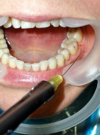 镶牙过程图解 (17)