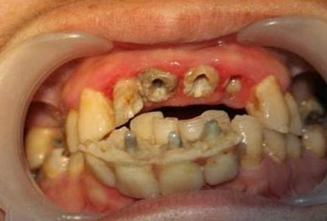 牙癌图片 晚期图片