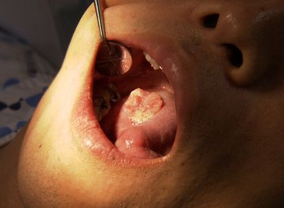 牙龈癌图片晚期 初期图片