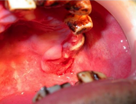 牙龈癌图片图片