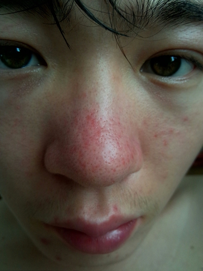 鼻子长螨虫症状图片 (20)