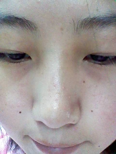 鼻子长螨虫症状图片 (26)