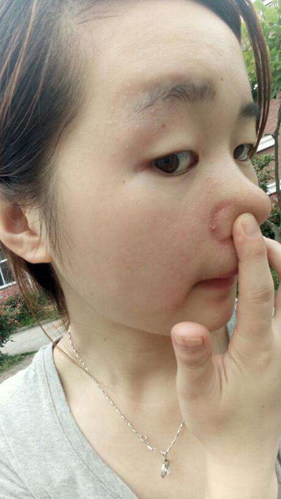 鼻子长螨虫症状图片 (39)