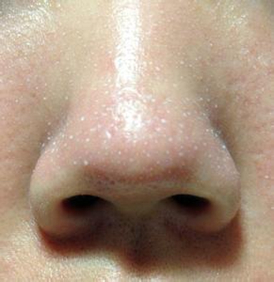 鼻子长螨虫症状图片 (52)