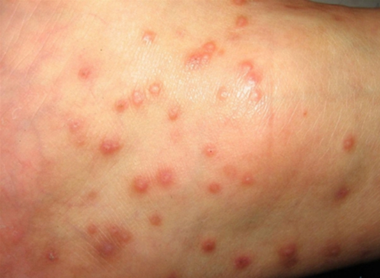 热毒湿疹症状图片湿气图片