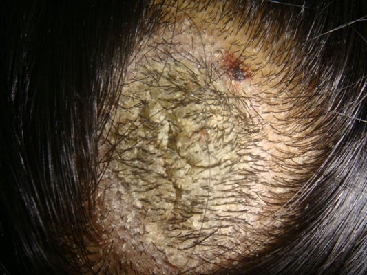 头皮真菌感染的症状图片
