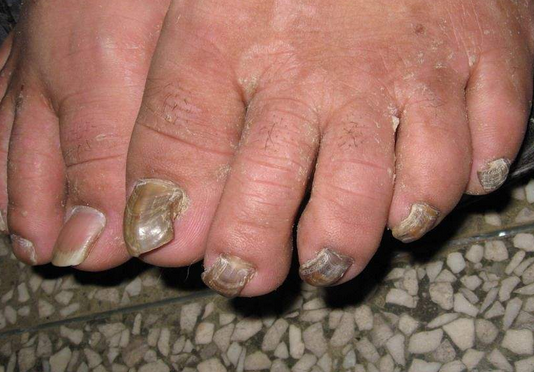 灰指甲早期症状图图片