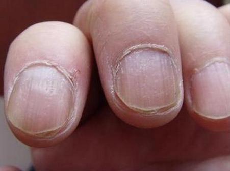 轻微灰指甲的症状图片图片