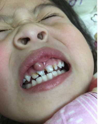 牙龈增生的症状图片