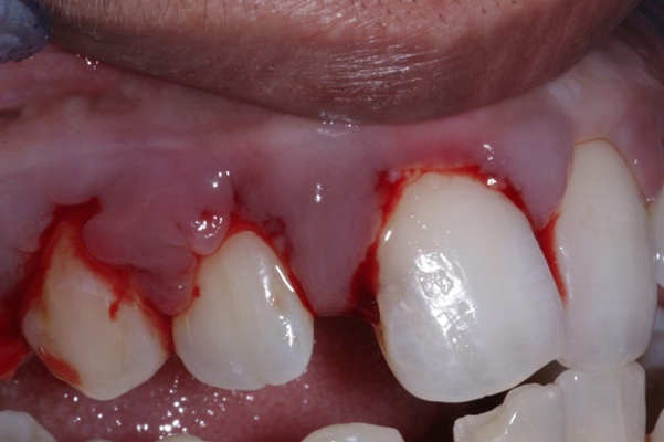 牙骨质增生症状图片图片