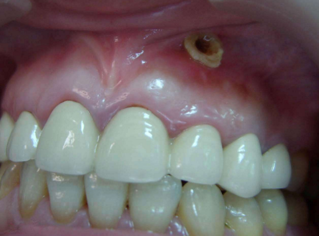牙龈增生分叶状图片图片