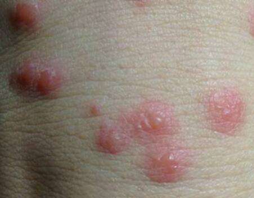 皮肤湿毒症状图片 (42)
