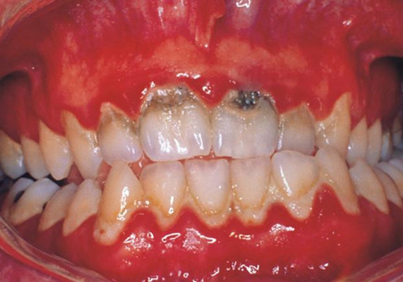 中西区龋齿专家_中西区治疗龋齿哪个专家好_中西区