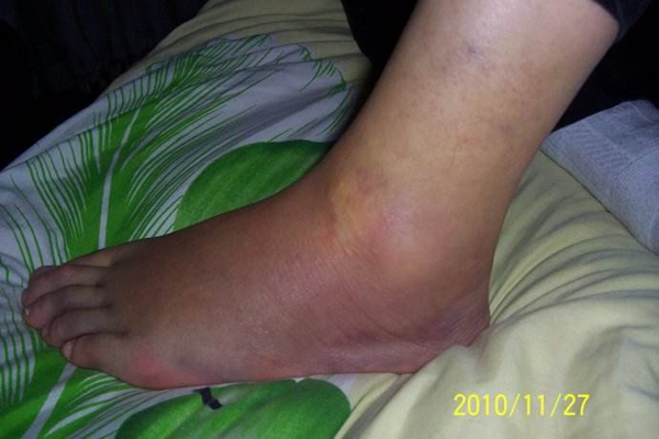脚受伤图片 (19)