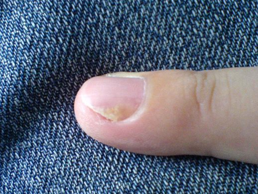 慢性灰指甲 初期图片
