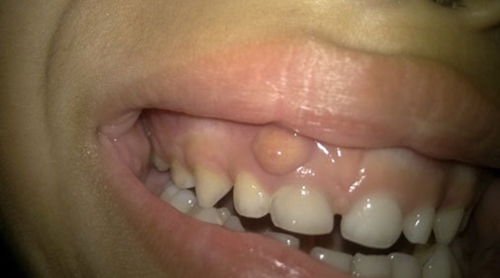 牙龈增生图片 骨质图片