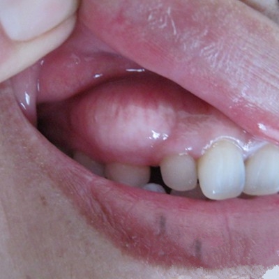 牙龈增生是什么原因图片