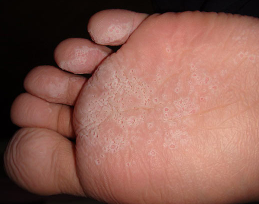湿性脚气病的症状图片图片