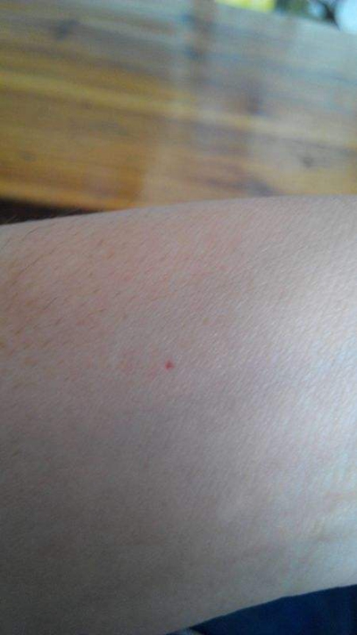 艾滋前期皮肤红点图片图片