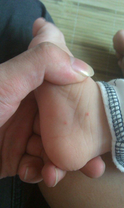 宝宝手足口病初期图片