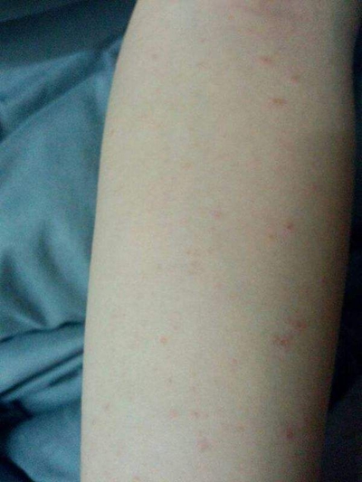 血热湿毒的皮肤症状图片