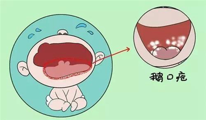 口腔念珠菌感染 (3)