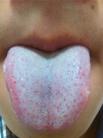 舌苔厚白图片 (11)