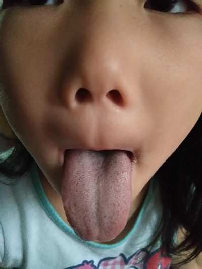 舌苔厚白图片 (17)