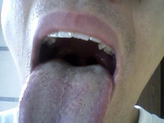 舌苔厚白图片 (36)