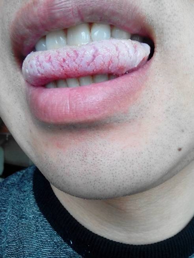 舌苔厚白图片 (39)