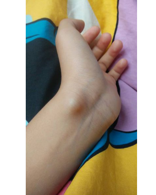 手腕腱鞘囊肿图片 (5)