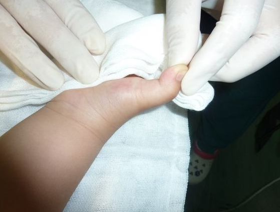 手腕腱鞘囊肿图片 (17)