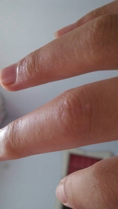手指水泡型湿疹图片 (18)