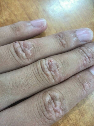 手指皮肤病图片图片
