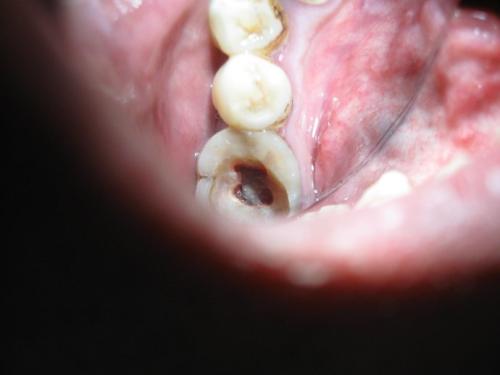 牙髓炎图片 (38)