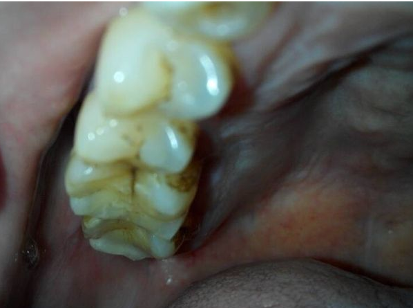 门牙牙髓炎图片图片