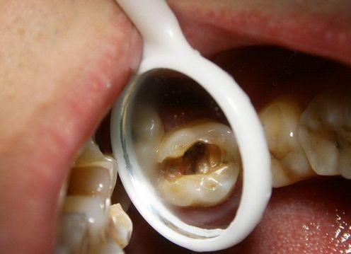 牙髓炎图片 (10)