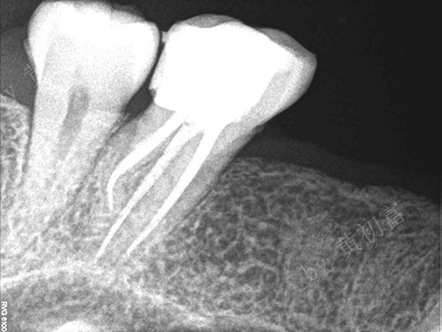 牙髓炎图片 (19)