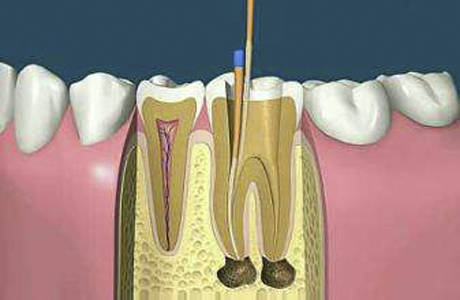 牙髓炎图片 (16)