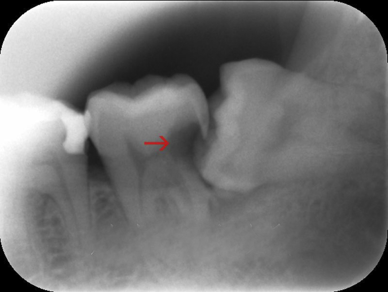 牙髓炎图片 (21)